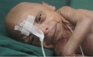 ‘Benjamin Button’ gerçek oldu