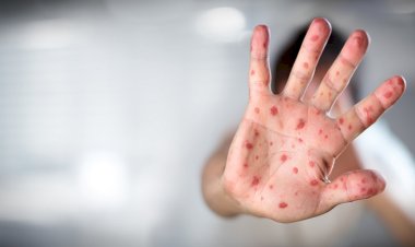 Maymun çiçeği virüsü yayılıyor: 12 ülkede görüldü