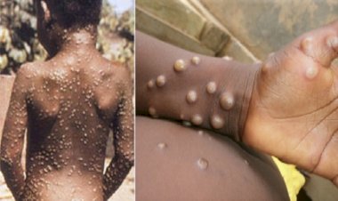 Maymun çiçeği virüsü İsrail’e sıçradı