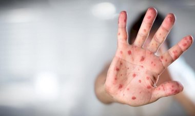 Türkiye'de ilk maymun çiçeği vakası tespit edildi