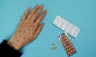 ABD'de maymun çiçeği salgınıyla ilgili korkutan gelişme