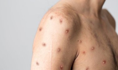 Türkiye'de 5 maymun çiçeği vakası tespit edildi